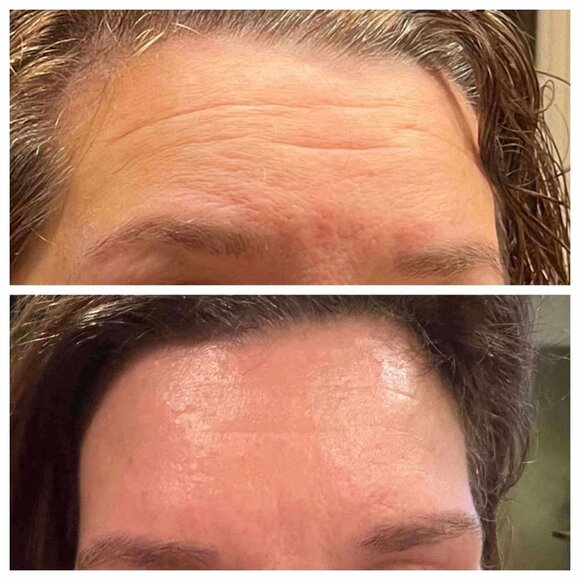 Tru Face® Line Corrector - Picture 4 of 5